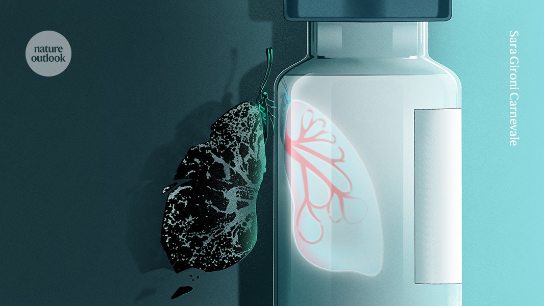 Treatments for idiopathic pulmonary fibrosis are on the horizon