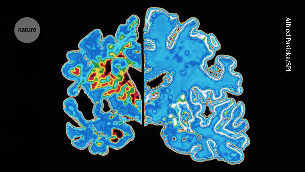 Blood test holds promise for predicting when Alzheimer's symptoms will start