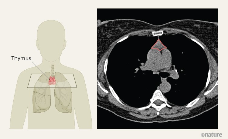 Thymus health is a predictor of lifelong well-being and immunotherapy effectiveness