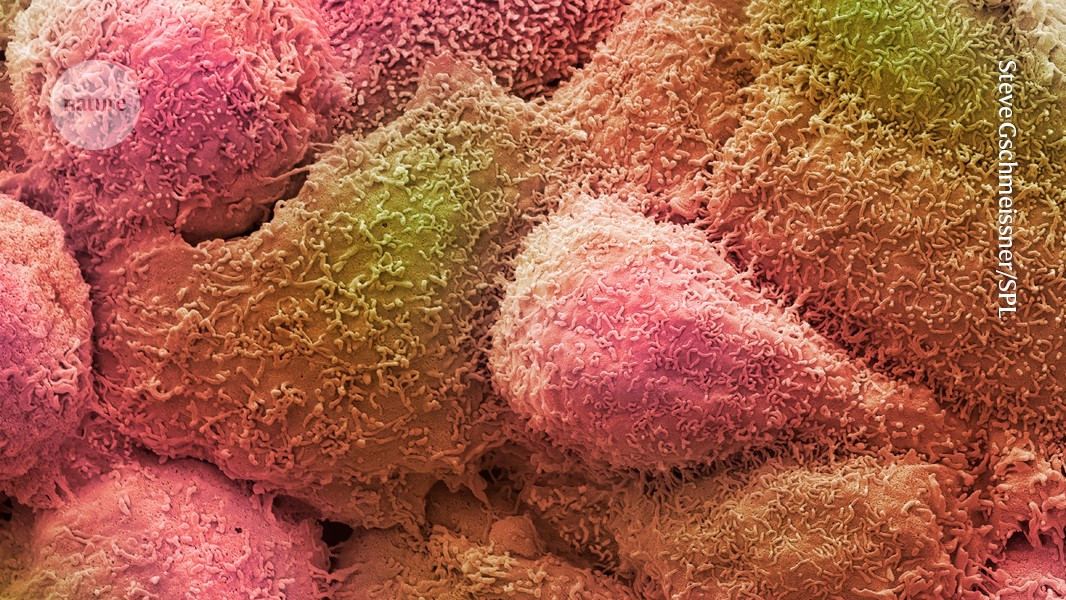 Biomarcador en sangre: Nueva esperanza para cáncer de mama triple nega