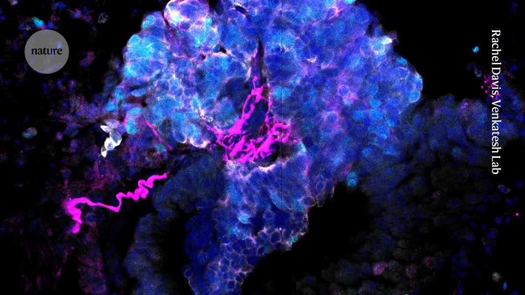 How the connection between lung cancer and the brain could lead to better treatments