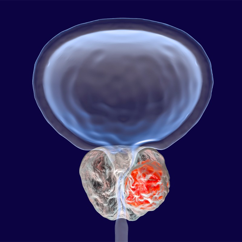 Androgen-Deprivation Therapy + Apalutamide: Potential New Treatment for High-Risk Localized Prostate Cancer