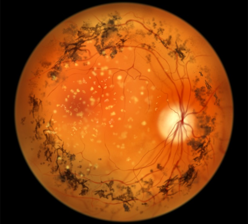 Optogenetic gene therapy shows early safety, some vision gains in blindness trial