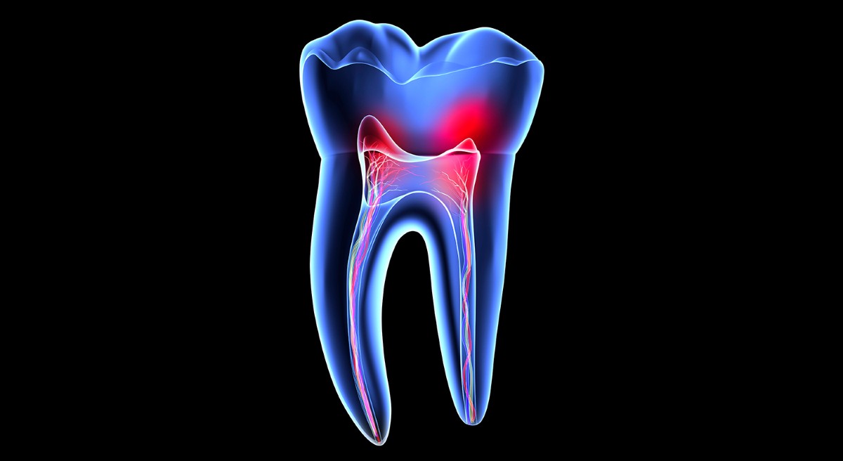 Rebuilding the natural defences of teeth