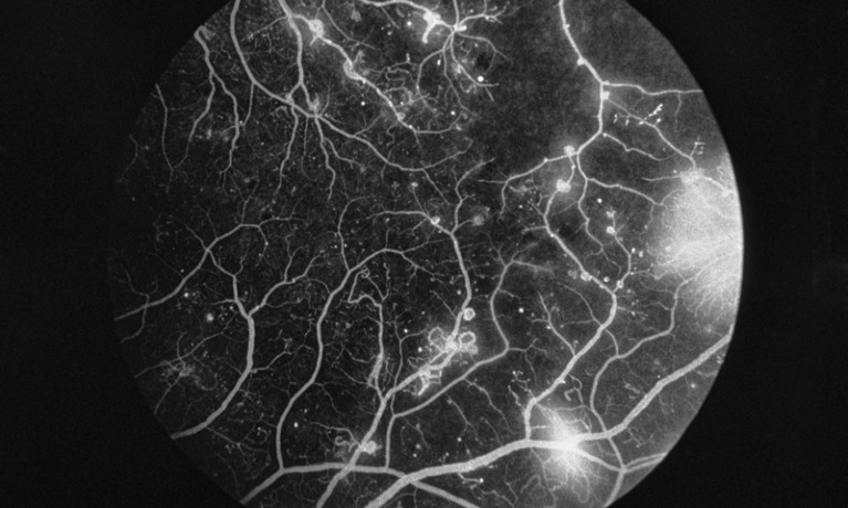 Fluorescence angiogram of retina with diabetic retinopathy