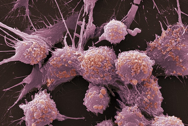 Coloured SEM of prostate cancer cells