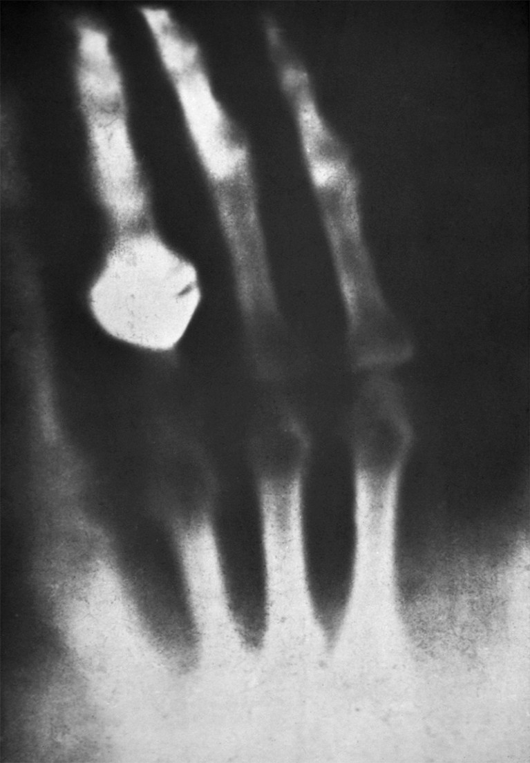 Image showing first x-ray of a human in 1895