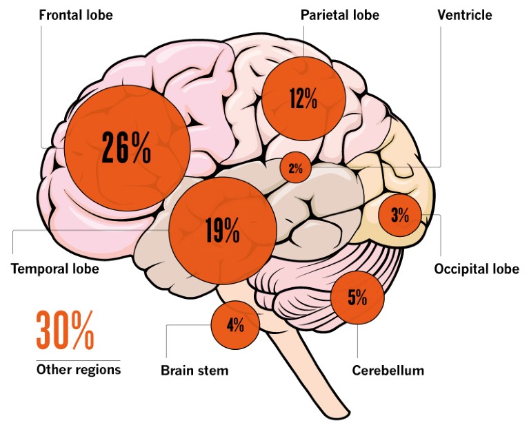 Most Common Primary Brain Tumor