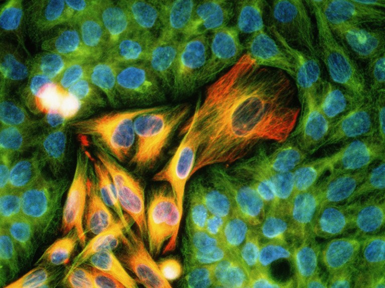 Immunofluorescent Light Micrograph of melanoma cancer cells