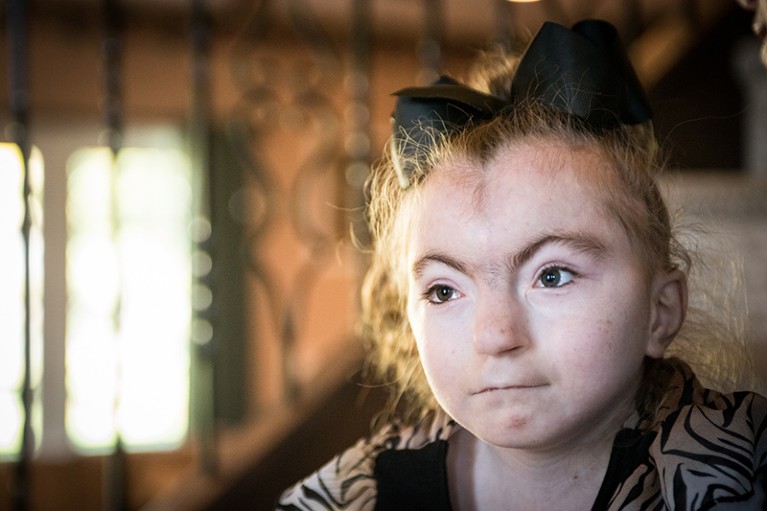 An 11-year-old girl who has Cornelia de Lange