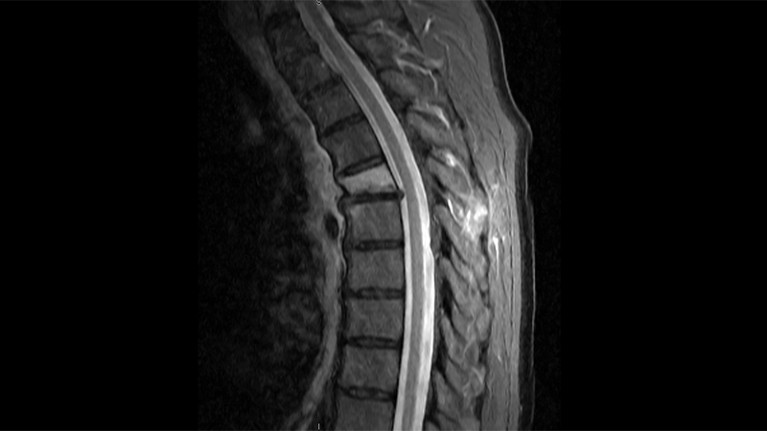 MRI of a spinal cord showing damage.