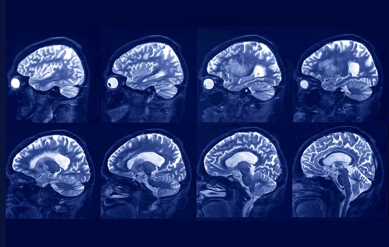 MRI scans of the brain of a patient aged over 60 with Alzheimer's disease.