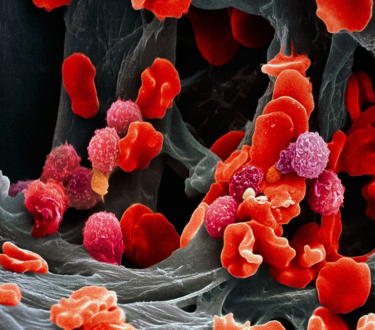 Scanning electron micrograph of leukaemia blood cells
