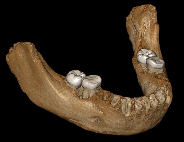 A computer model of a whole jawbone.