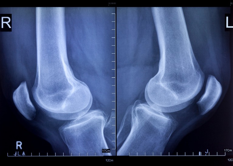 X-rays of left and right knees, lateral view.