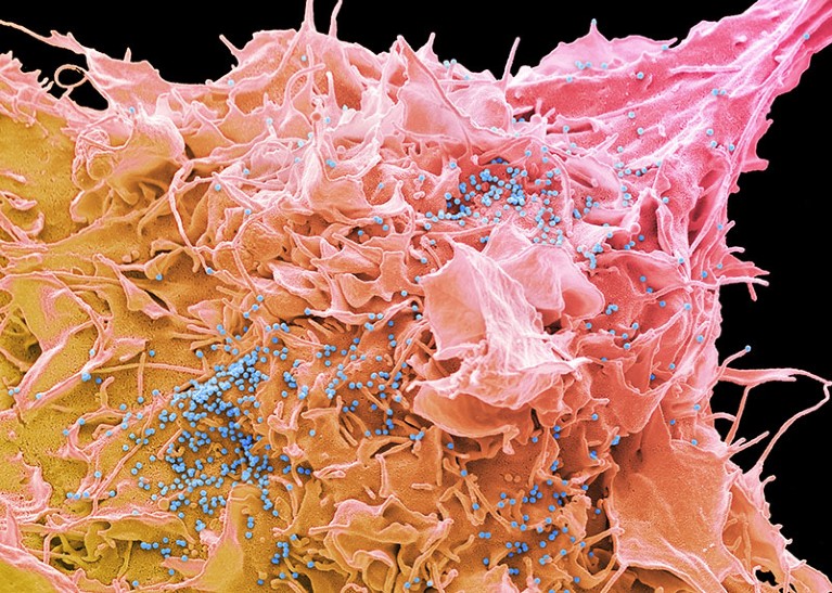 Coloured scanning electron micrograph of an HIV infected 293T cell