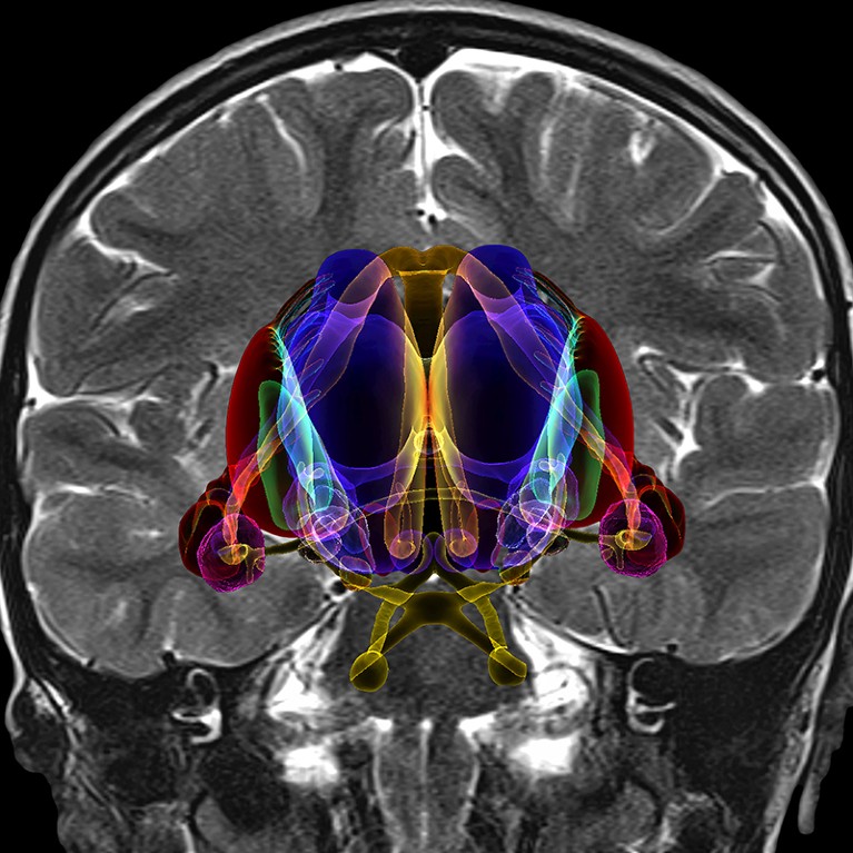 An MRI-based illustration of the human brain and limbic system