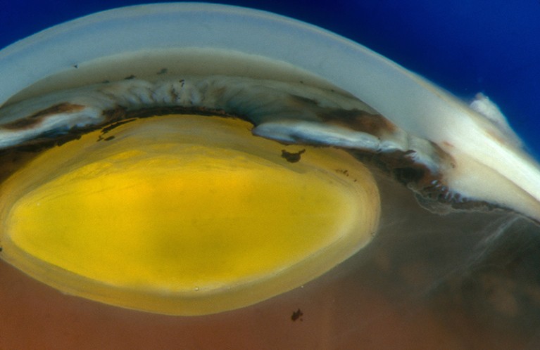 Anterior segment of human eye showing cornea, iris, and lens.