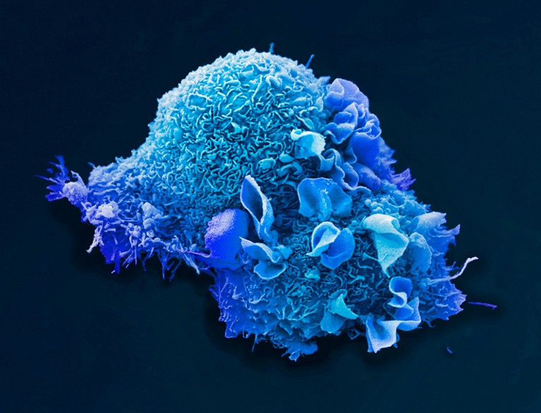 Lung cancer cell, coloured scanning electron micrograph