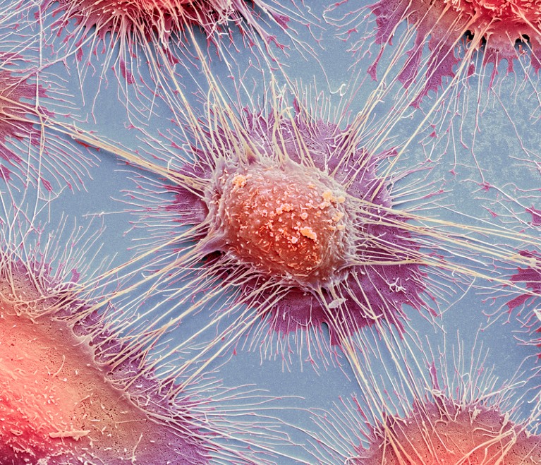 Coloured scanning electron micrograph of squamous cell carcinoma cells from a human mouth.