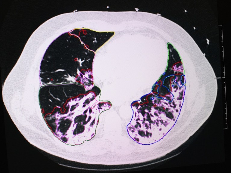 A Covid-19 patient's reduced lung capacity MRI scan results in the intensive care unit (ICU), France.