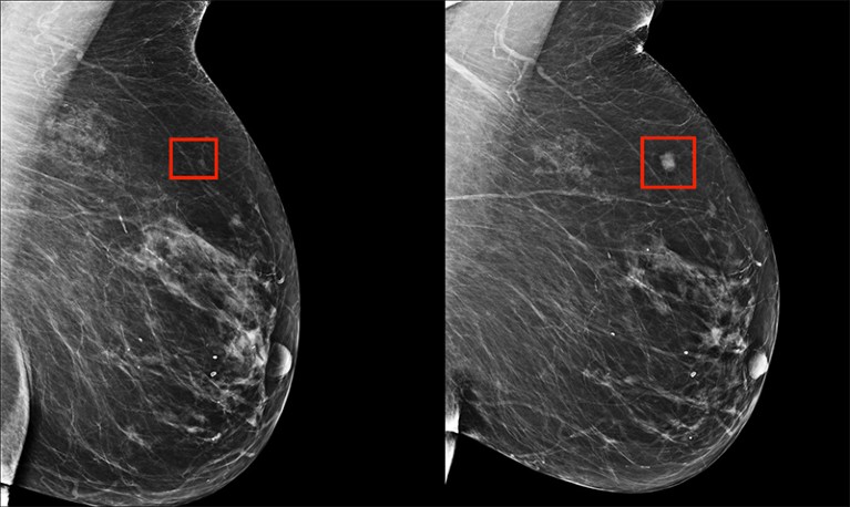 Two scans of breast cancer