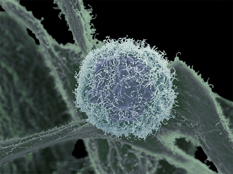 A scanning electron micrograph of a skin cancer cell