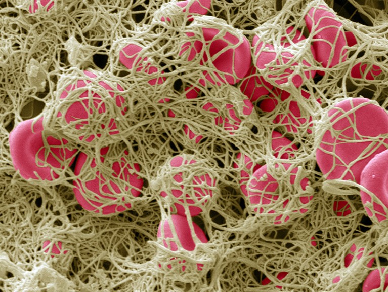 Coloured scanning electron micrograph of a blood clot