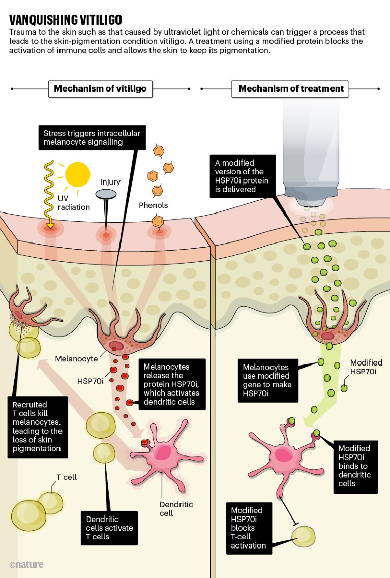 latest research in vitiligo treatment 2023