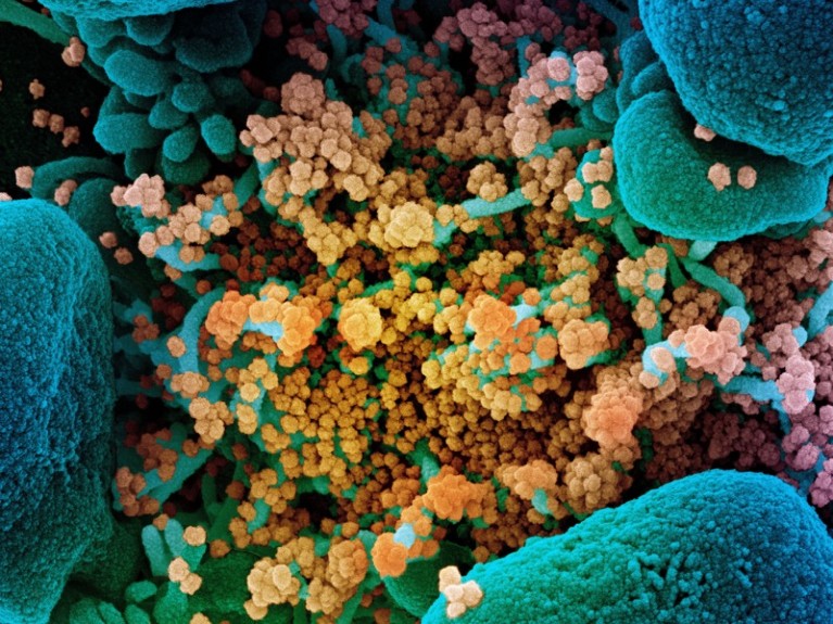 SEM of SARS-CoV-2 coronavirus particles (orange) on an apoptotic cell (blue) from a US patient sample. SARS-CoV-2.
