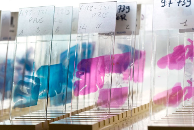 Glass slides prepared with pink and blue stained samples of brain tissue affected by Alzheimer's disease