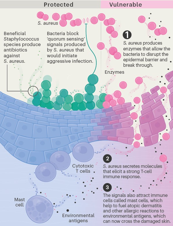 Taming Staphylococcus aureus in the eczema skin microbiome