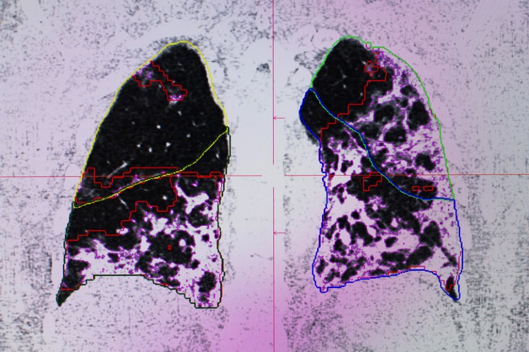 An MRI scan of a COVID-19 patients lungs showing areas of black and white