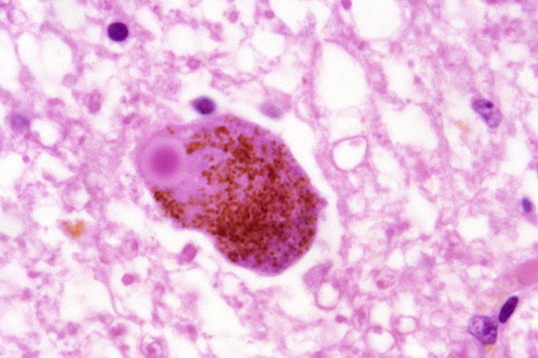 含有路易体(圆形，紫色)的神经元(神经细胞，红色)切片的光学显微照片