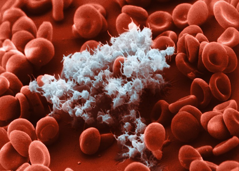 Coloured scanning electron micrograph of activated platelets (white) and red blood cells as a blood clot begins to form.