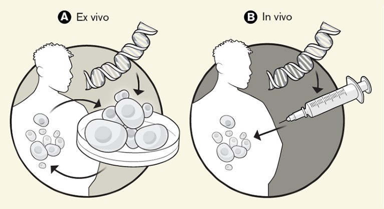 Schematic showing basic principles for ex vivo and in vivo gene therapy