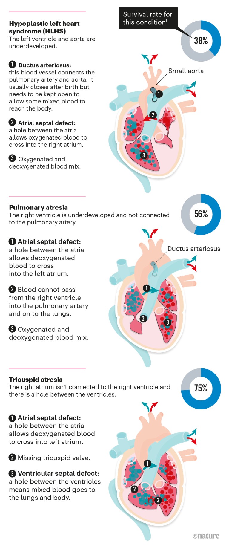 Graphic illustrating three kinds of heart defect