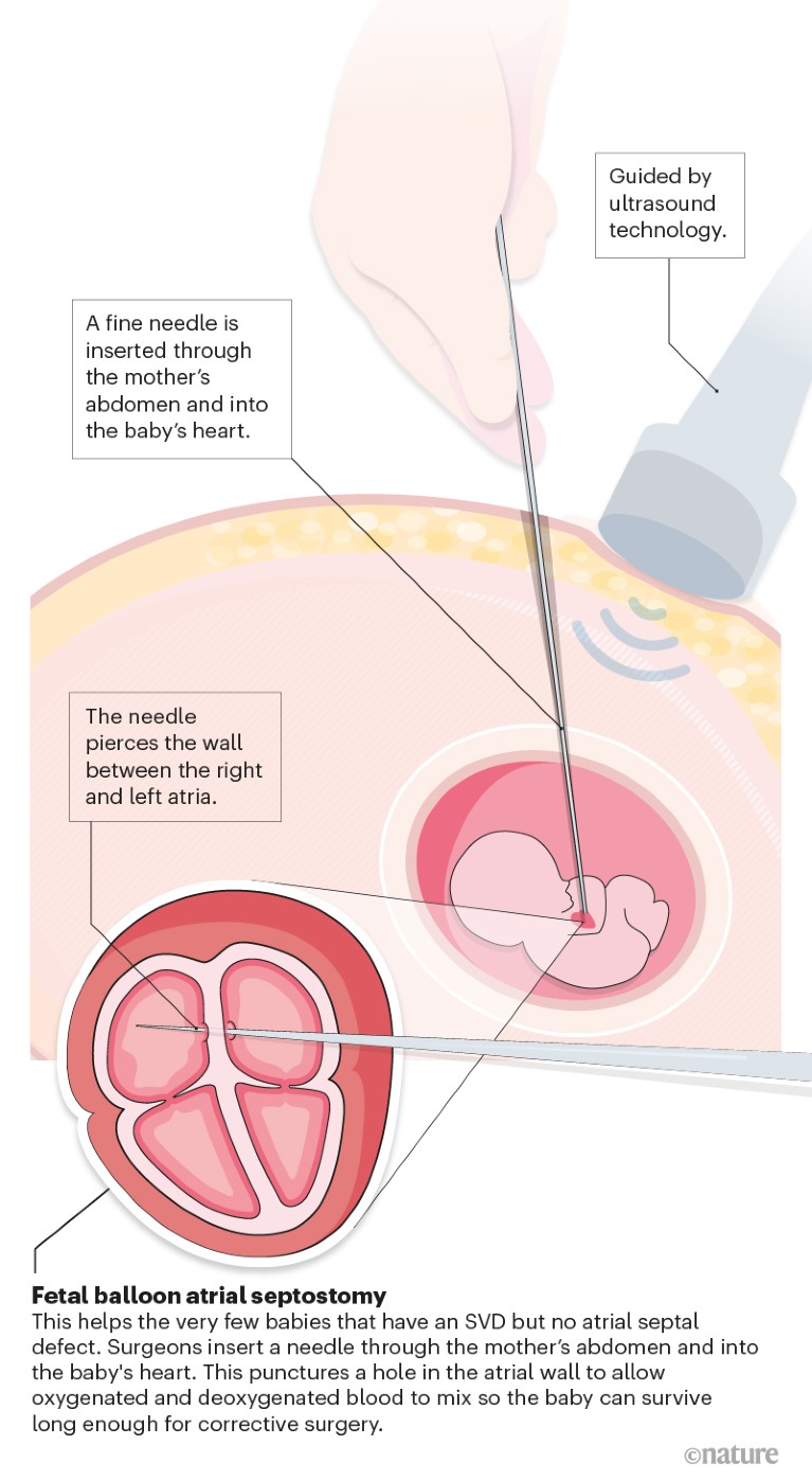 Graphic illustrating featl balloon atrial septostomy