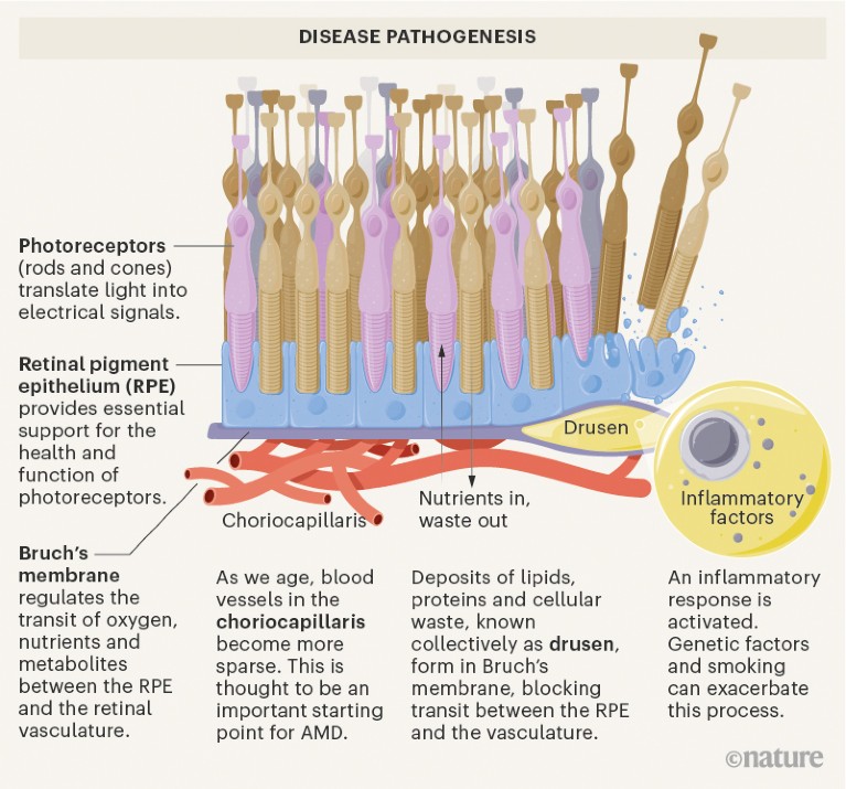 Graphic showing disease pathogenesis for AMD