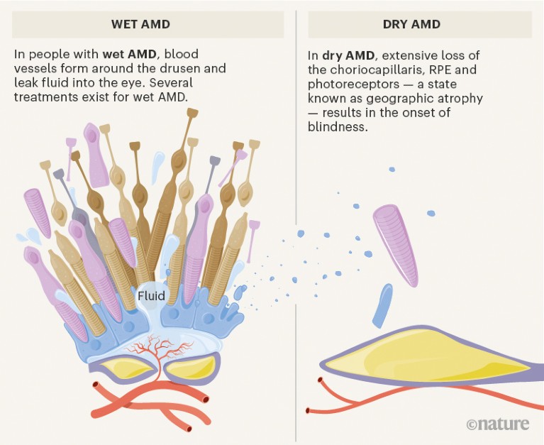 Graphic showing pathogenesis specific to wet and dry AMD