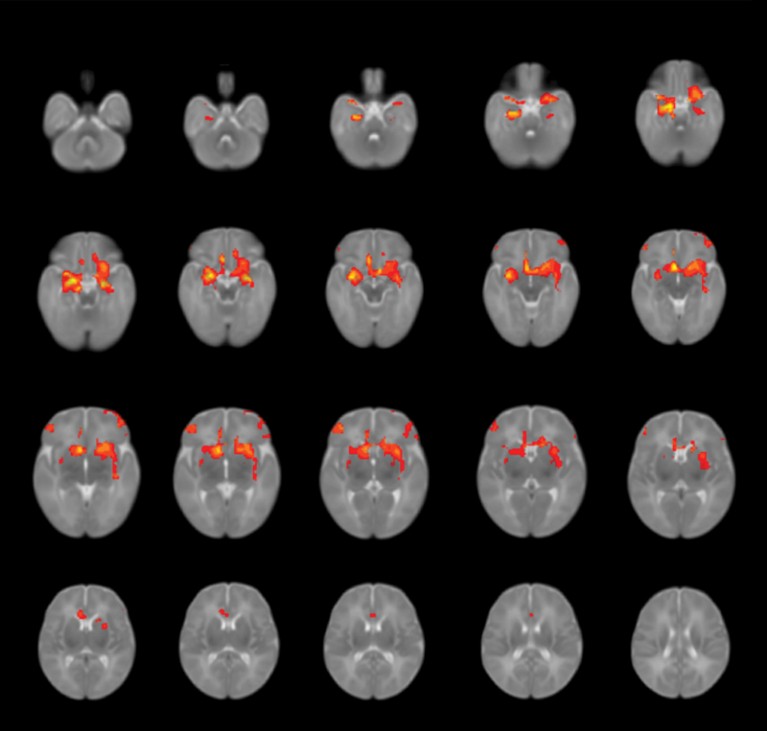 Composite of MRI scans of brains showing amygdala functional connectivity in infants born during born during the pandemic