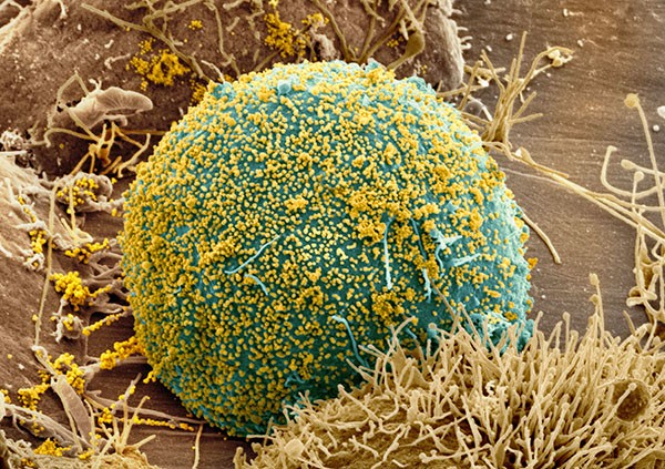Coloured scanning electron micrograph (SEM) of HIV particles (yellow) budding from the membrane of a host cell (blue).
