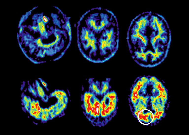 PET Scans, top row, normal brains and bottom row, Alzheimer brains.