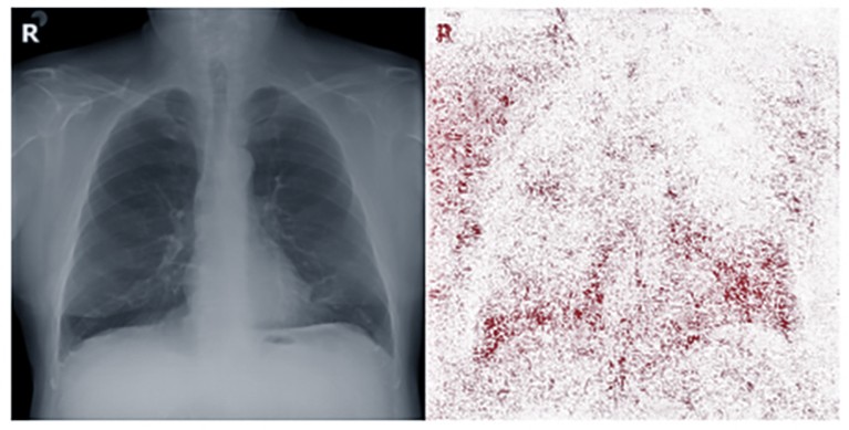 X-ray of human chest alongside same chest with red highlights to show what AI considers important areas