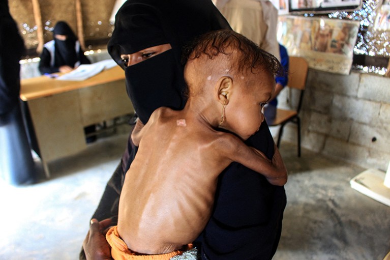 A baby in Yemen suffers from severe malnutrition, awaiting treatment while in her mother's arms at a humanitarian organisation.