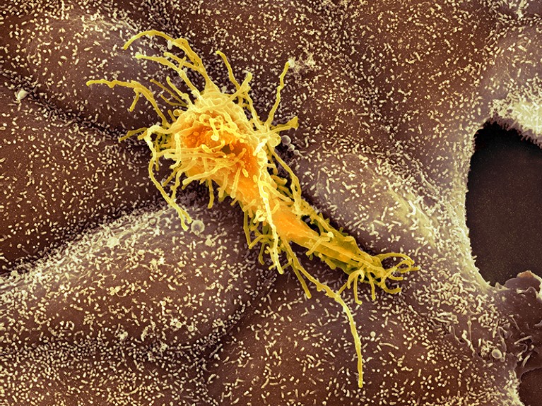 Coloured scanning electron micrograph of a cancer cell (yellow) migrating along a layer of normal epithelial cells (brown).