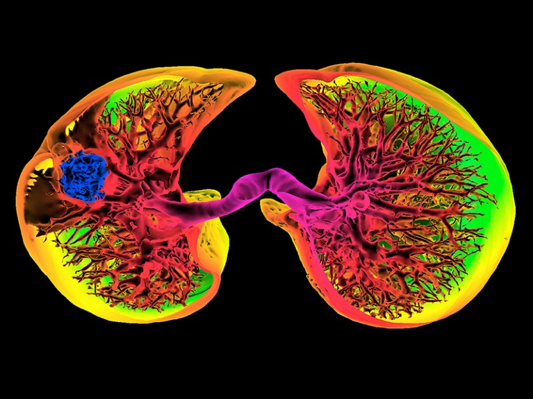 Coloured 3D axial computed tomography (CT) scan of human lungs with cancer.