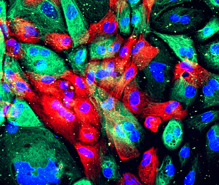 Colourful micrograph of prostate cancer cells