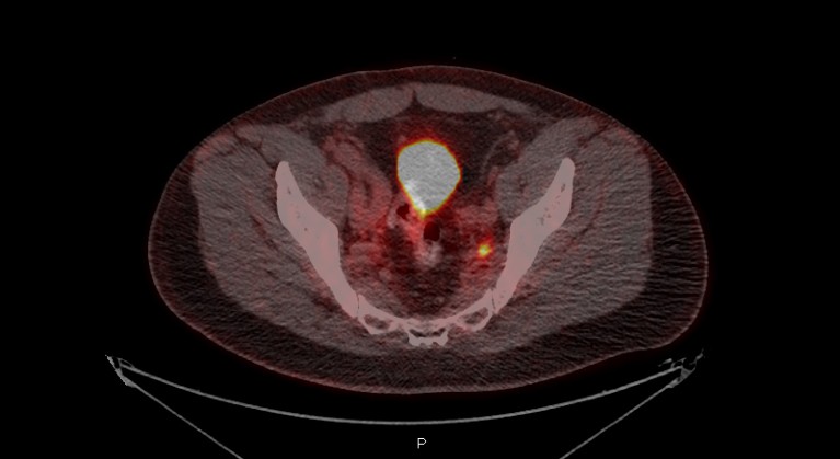 A scan of a pelvic lymph node showing metastatic cancer