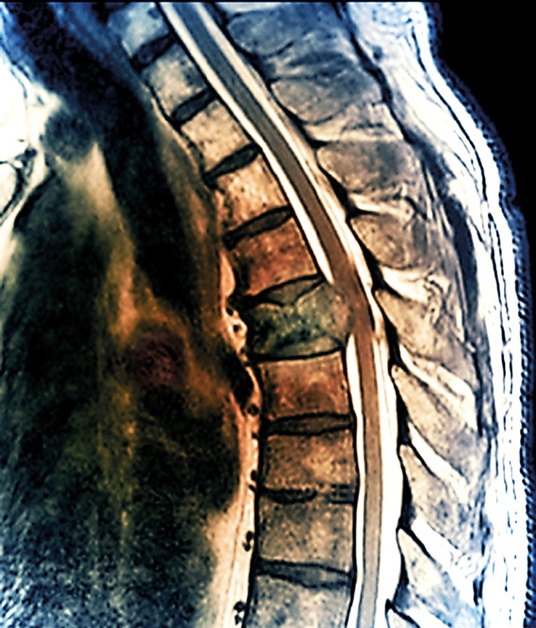 An MRI showing a spine with cancer at centre